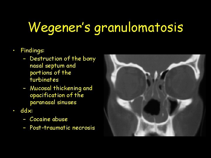 Wegener’s granulomatosis • Findings: – Destruction of the bony nasal septum and portions of Wegener’s granulomatosis • Findings: – Destruction of the bony nasal septum and portions of