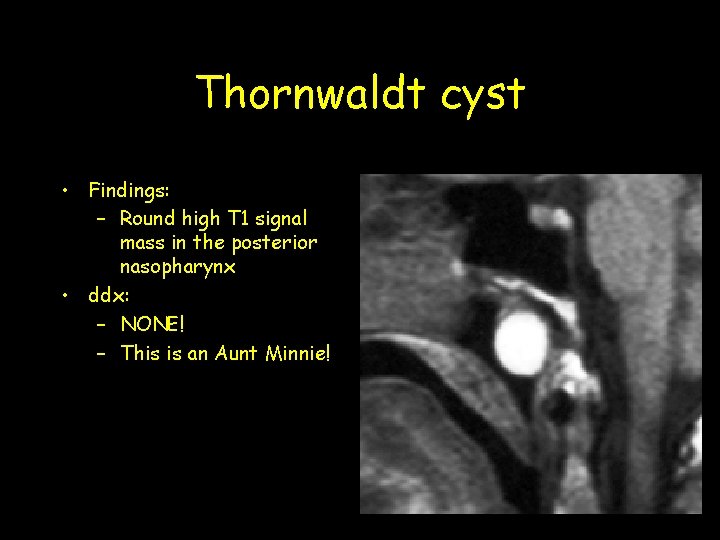 Thornwaldt cyst • Findings: – Round high T 1 signal mass in the posterior Thornwaldt cyst • Findings: – Round high T 1 signal mass in the posterior