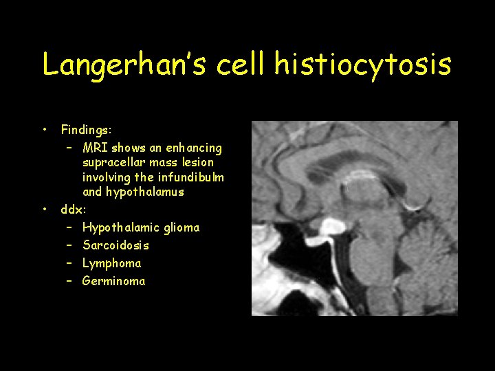 Langerhan’s cell histiocytosis • • Findings: – MRI shows an enhancing supracellar mass lesion Langerhan’s cell histiocytosis • • Findings: – MRI shows an enhancing supracellar mass lesion