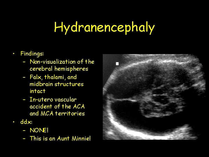 Hydranencephaly • Findings: – Non-visualization of the cerebral hemispheres – Falx, thalami, and midbrain Hydranencephaly • Findings: – Non-visualization of the cerebral hemispheres – Falx, thalami, and midbrain