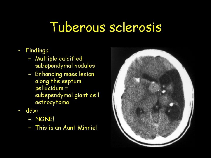 Tuberous sclerosis • Findings: – Multiple calcified subependymal nodules – Enhancing mass lesion along Tuberous sclerosis • Findings: – Multiple calcified subependymal nodules – Enhancing mass lesion along