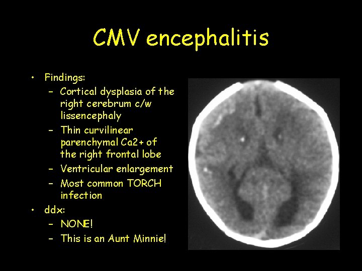 CMV encephalitis • Findings: – Cortical dysplasia of the right cerebrum c/w lissencephaly – CMV encephalitis • Findings: – Cortical dysplasia of the right cerebrum c/w lissencephaly –