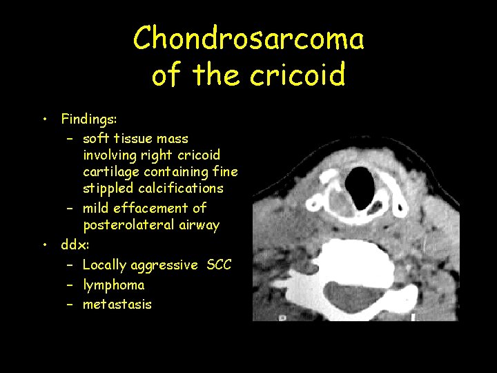 Chondrosarcoma of the cricoid • Findings: – soft tissue mass involving right cricoid cartilage Chondrosarcoma of the cricoid • Findings: – soft tissue mass involving right cricoid cartilage