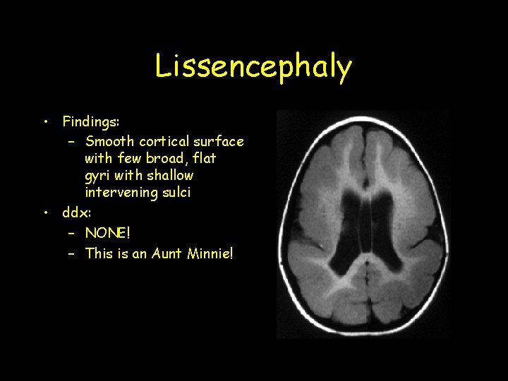 Lissencephaly • Findings: – Smooth cortical surface with few broad, flat gyri with shallow Lissencephaly • Findings: – Smooth cortical surface with few broad, flat gyri with shallow