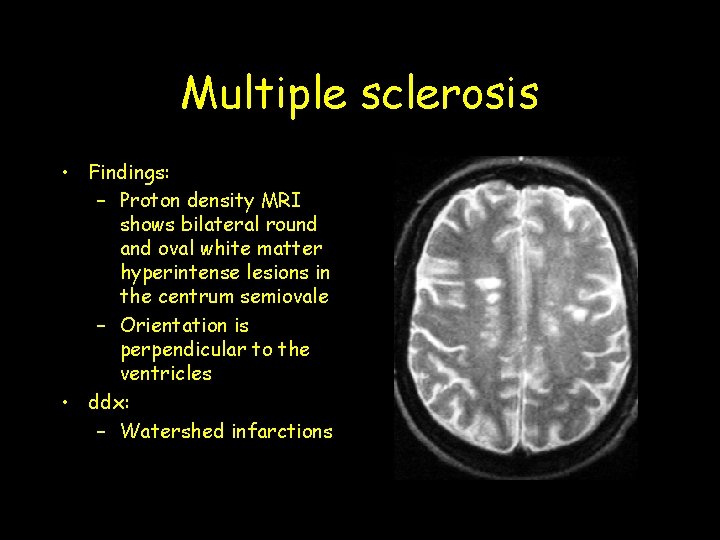 Multiple sclerosis • Findings: – Proton density MRI shows bilateral round and oval white Multiple sclerosis • Findings: – Proton density MRI shows bilateral round and oval white