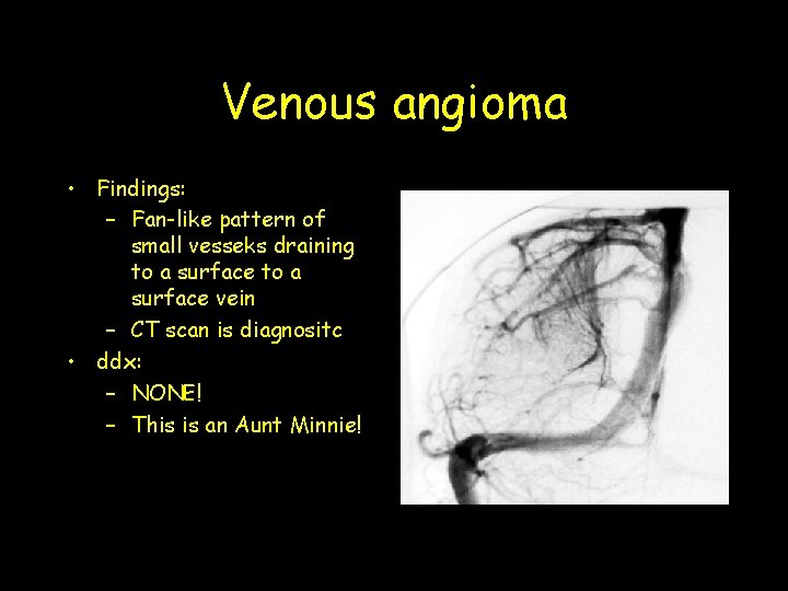 Venous angioma • Findings: – Fan-like pattern of small vesseks draining to a surface Venous angioma • Findings: – Fan-like pattern of small vesseks draining to a surface