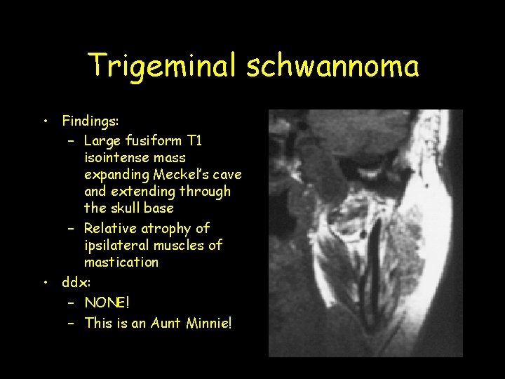 Trigeminal schwannoma • Findings: – Large fusiform T 1 isointense mass expanding Meckel’s cave Trigeminal schwannoma • Findings: – Large fusiform T 1 isointense mass expanding Meckel’s cave