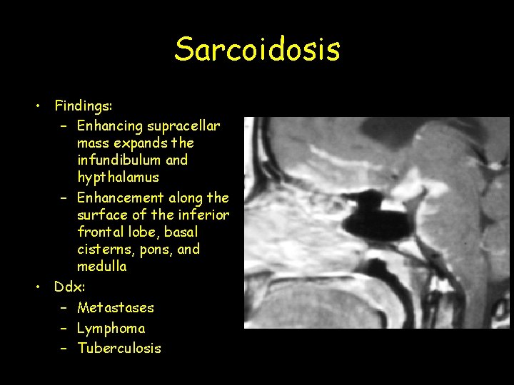 Sarcoidosis • Findings: – Enhancing supracellar mass expands the infundibulum and hypthalamus – Enhancement Sarcoidosis • Findings: – Enhancing supracellar mass expands the infundibulum and hypthalamus – Enhancement