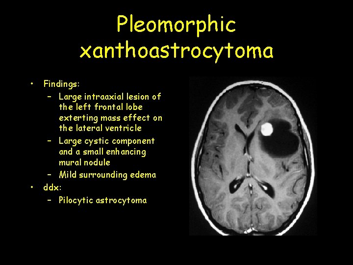 Pleomorphic xanthoastrocytoma • • Findings: – Large intraaxial lesion of the left frontal lobe Pleomorphic xanthoastrocytoma • • Findings: – Large intraaxial lesion of the left frontal lobe