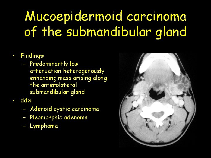 Mucoepidermoid carcinoma of the submandibular gland • Findings: – Predominantly low attenuation heterogenously enhancing Mucoepidermoid carcinoma of the submandibular gland • Findings: – Predominantly low attenuation heterogenously enhancing