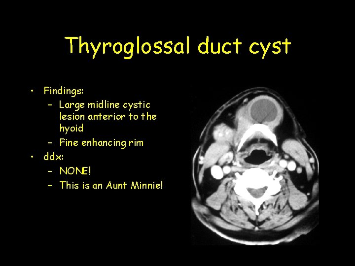 Thyroglossal duct cyst • Findings: – Large midline cystic lesion anterior to the hyoid Thyroglossal duct cyst • Findings: – Large midline cystic lesion anterior to the hyoid