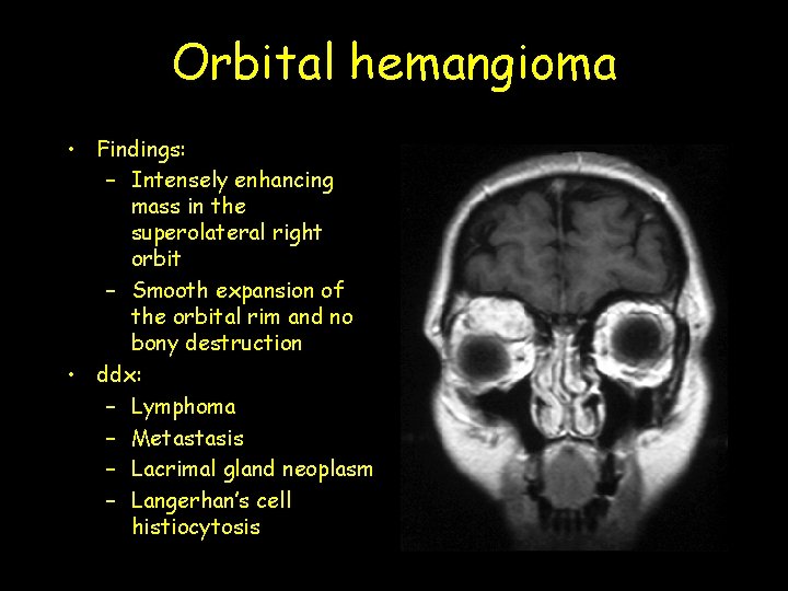 Orbital hemangioma • Findings: – Intensely enhancing mass in the superolateral right orbit – Orbital hemangioma • Findings: – Intensely enhancing mass in the superolateral right orbit –