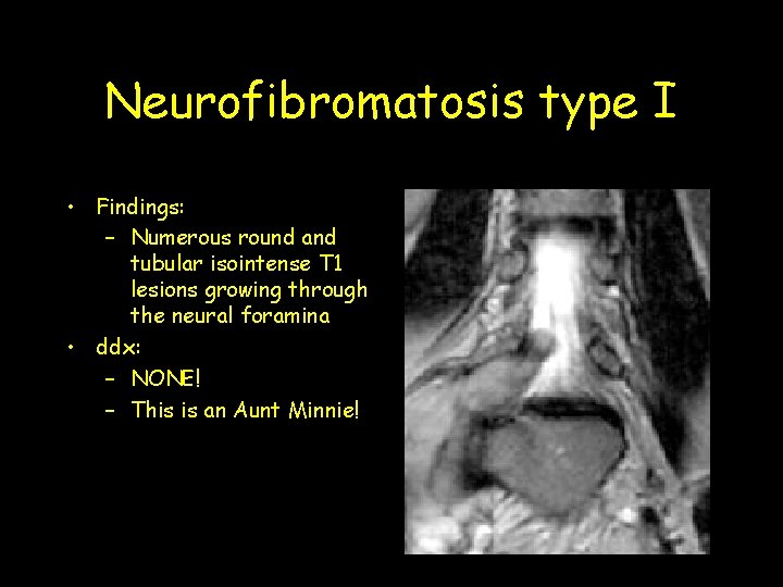 Neurofibromatosis type I • Findings: – Numerous round and tubular isointense T 1 lesions Neurofibromatosis type I • Findings: – Numerous round and tubular isointense T 1 lesions