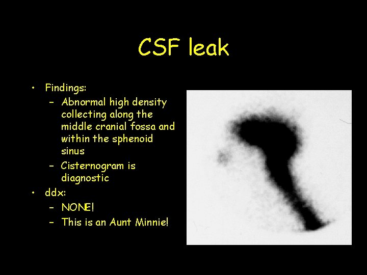CSF leak • Findings: – Abnormal high density collecting along the middle cranial fossa CSF leak • Findings: – Abnormal high density collecting along the middle cranial fossa