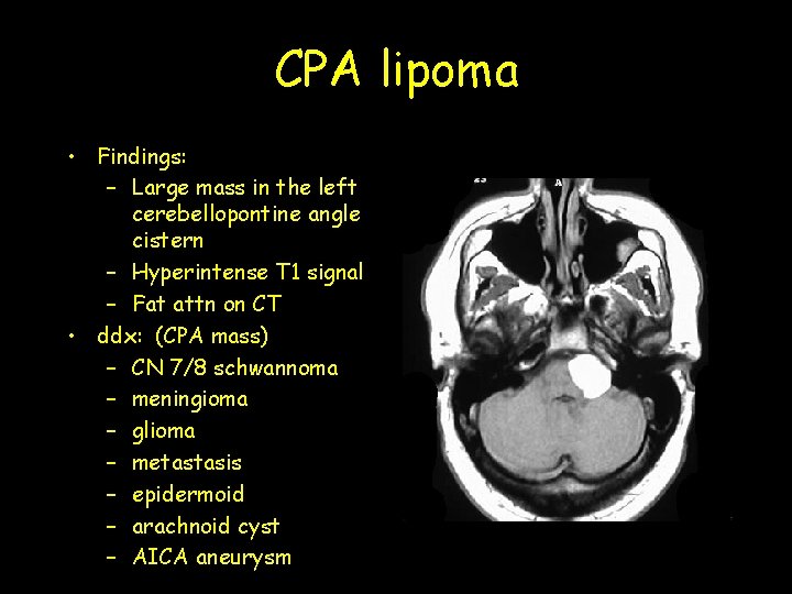 CPA lipoma • Findings: – Large mass in the left cerebellopontine angle cistern – CPA lipoma • Findings: – Large mass in the left cerebellopontine angle cistern –