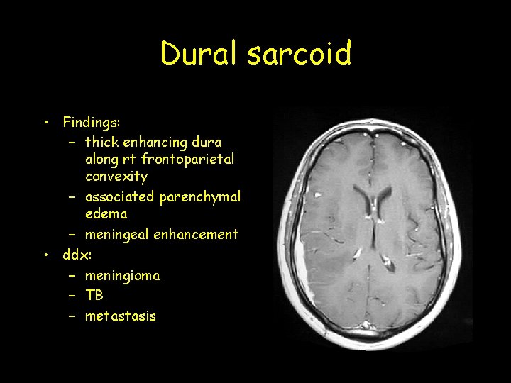 Dural sarcoid • Findings: – thick enhancing dura along rt frontoparietal convexity – associated Dural sarcoid • Findings: – thick enhancing dura along rt frontoparietal convexity – associated