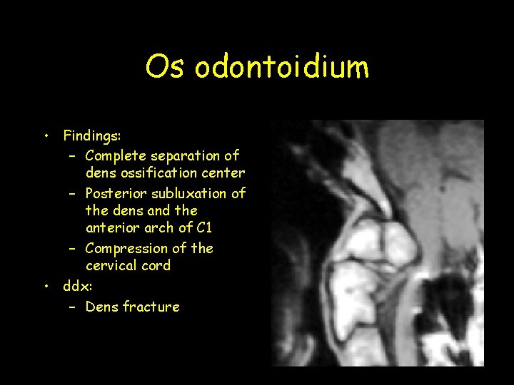 Os odontoidium • Findings: – Complete separation of dens ossification center – Posterior subluxation Os odontoidium • Findings: – Complete separation of dens ossification center – Posterior subluxation
