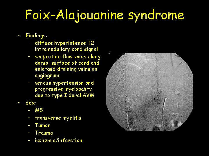 Foix-Alajouanine syndrome • • Findings: – diffuse hyperintense T 2 intramedullary cord signal – Foix-Alajouanine syndrome • • Findings: – diffuse hyperintense T 2 intramedullary cord signal –