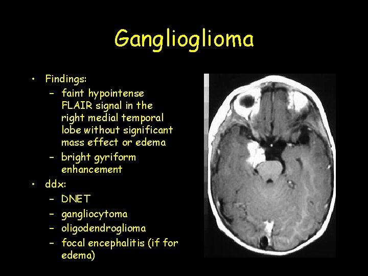 Ganglioma • Findings: – faint hypointense FLAIR signal in the right medial temporal lobe Ganglioma • Findings: – faint hypointense FLAIR signal in the right medial temporal lobe
