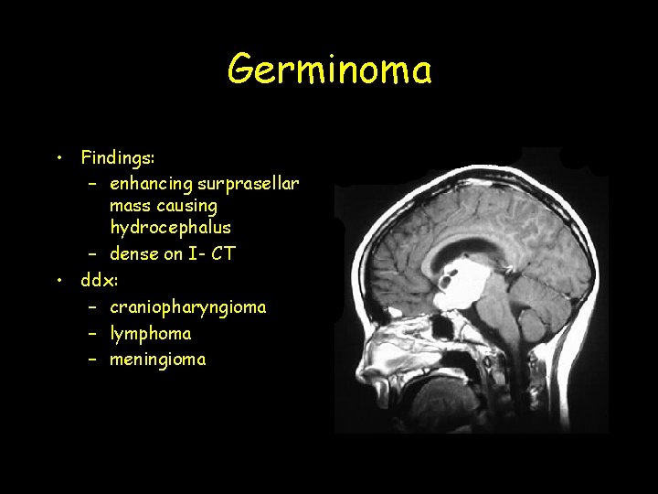 Germinoma • Findings: – enhancing surprasellar mass causing hydrocephalus – dense on I- CT Germinoma • Findings: – enhancing surprasellar mass causing hydrocephalus – dense on I- CT