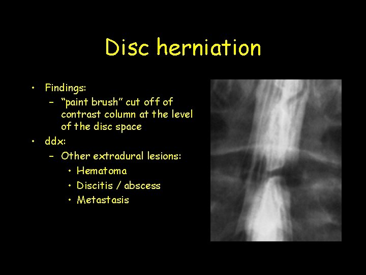 Disc herniation • Findings: – “paint brush” cut off of contrast column at the Disc herniation • Findings: – “paint brush” cut off of contrast column at the