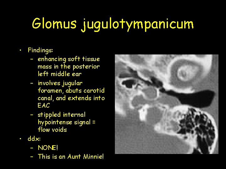 Glomus jugulotympanicum • Findings: – enhancing soft tissue mass in the posterior left middle Glomus jugulotympanicum • Findings: – enhancing soft tissue mass in the posterior left middle
