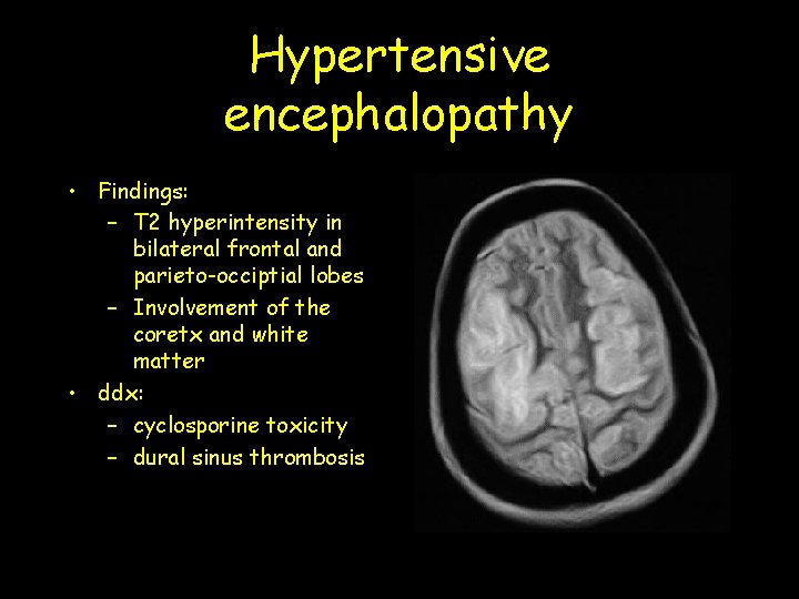 Hypertensive encephalopathy • Findings: – T 2 hyperintensity in bilateral frontal and parieto-occiptial lobes Hypertensive encephalopathy • Findings: – T 2 hyperintensity in bilateral frontal and parieto-occiptial lobes