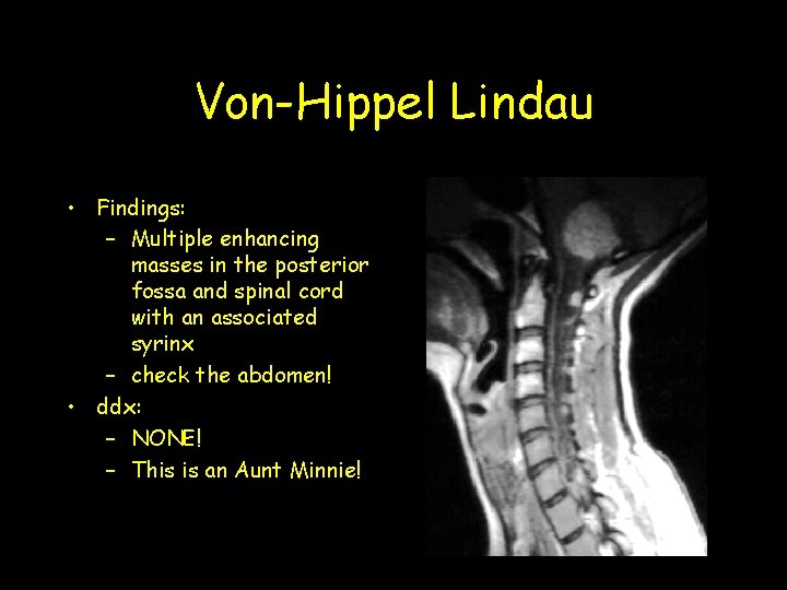 Von-Hippel Lindau • Findings: – Multiple enhancing masses in the posterior fossa and spinal Von-Hippel Lindau • Findings: – Multiple enhancing masses in the posterior fossa and spinal