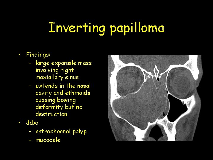 Inverting papilloma • Findings: – large expansile mass involving right maxiallary sinus – extends Inverting papilloma • Findings: – large expansile mass involving right maxiallary sinus – extends