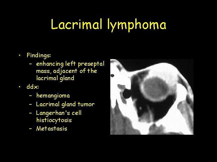 Lacrimal lymphoma • Findings: – enhancing left preseptal mass, adjacent of the lacrimal gland Lacrimal lymphoma • Findings: – enhancing left preseptal mass, adjacent of the lacrimal gland