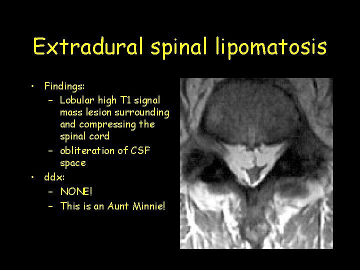 Extradural spinal lipomatosis • Findings: – Lobular high T 1 signal mass lesion surrounding Extradural spinal lipomatosis • Findings: – Lobular high T 1 signal mass lesion surrounding