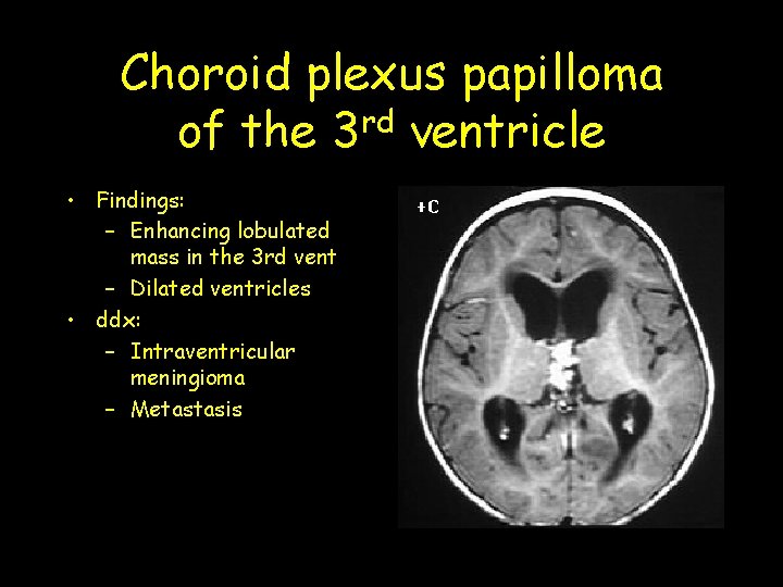 Choroid plexus papilloma of the 3 rd ventricle • Findings: – Enhancing lobulated mass Choroid plexus papilloma of the 3 rd ventricle • Findings: – Enhancing lobulated mass