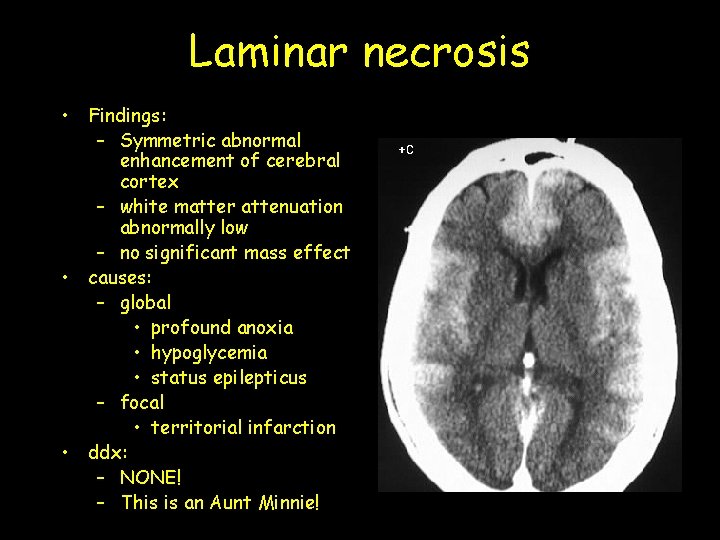 Laminar necrosis • Findings: – Symmetric abnormal enhancement of cerebral cortex – white matter Laminar necrosis • Findings: – Symmetric abnormal enhancement of cerebral cortex – white matter