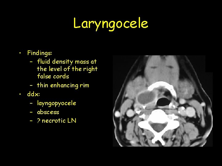 Laryngocele • Findings: – fluid density mass at the level of the right false Laryngocele • Findings: – fluid density mass at the level of the right false