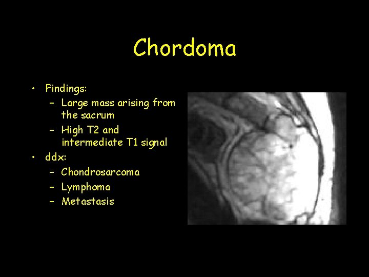 Chordoma • Findings: – Large mass arising from the sacrum – High T 2 Chordoma • Findings: – Large mass arising from the sacrum – High T 2