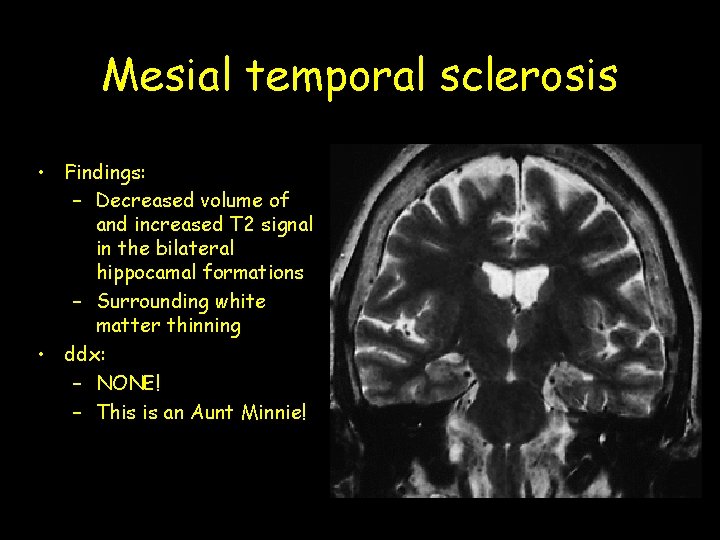 Mesial temporal sclerosis • Findings: – Decreased volume of and increased T 2 signal Mesial temporal sclerosis • Findings: – Decreased volume of and increased T 2 signal