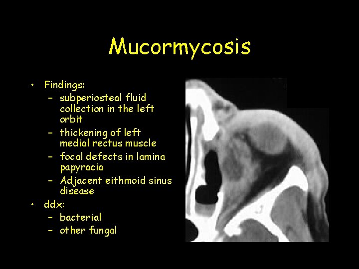Mucormycosis • Findings: – subperiosteal fluid collection in the left orbit – thickening of Mucormycosis • Findings: – subperiosteal fluid collection in the left orbit – thickening of