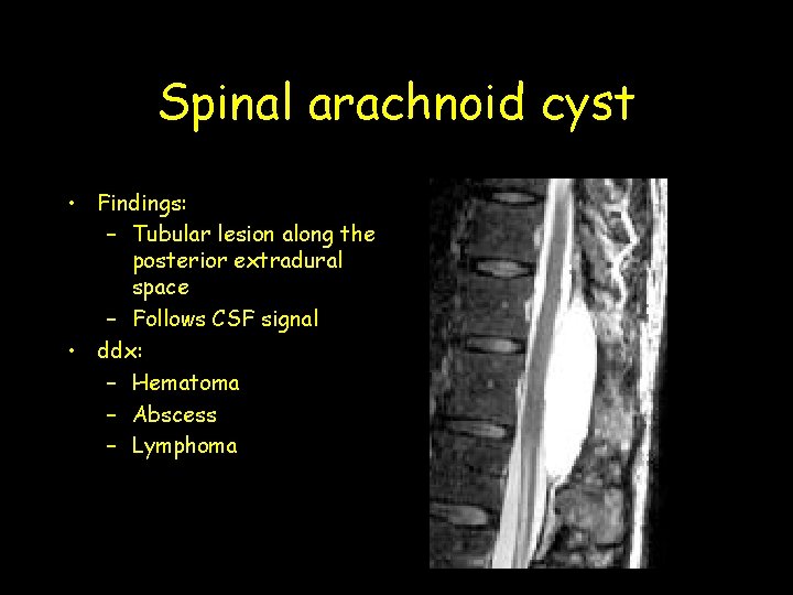 Spinal arachnoid cyst • Findings: – Tubular lesion along the posterior extradural space – Spinal arachnoid cyst • Findings: – Tubular lesion along the posterior extradural space –