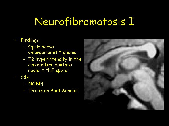 Neurofibromatosis I • Findings: – Optic nerve enlargemenet = glioma – T 2 hyperintensity Neurofibromatosis I • Findings: – Optic nerve enlargemenet = glioma – T 2 hyperintensity