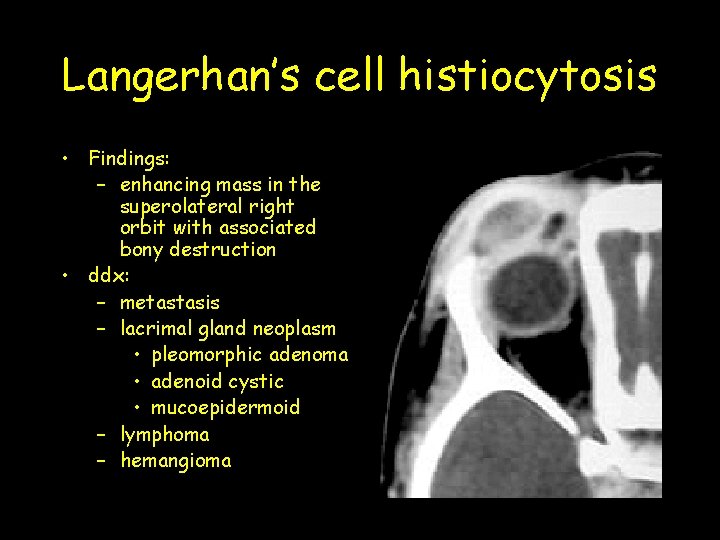 Langerhan’s cell histiocytosis • Findings: – enhancing mass in the superolateral right orbit with Langerhan’s cell histiocytosis • Findings: – enhancing mass in the superolateral right orbit with
