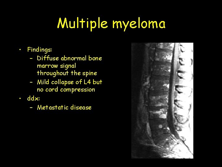 Multiple myeloma • Findings: – Diffuse abnormal bone marrow signal throughout the spine – Multiple myeloma • Findings: – Diffuse abnormal bone marrow signal throughout the spine –