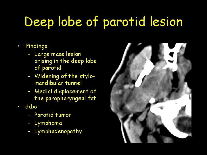 Deep lobe of parotid lesion • Findings: – Large mass lesion arising in the Deep lobe of parotid lesion • Findings: – Large mass lesion arising in the