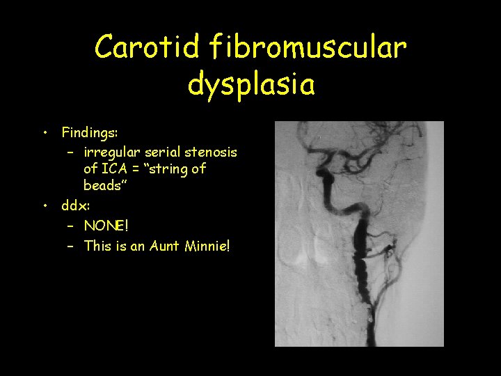 Carotid fibromuscular dysplasia • Findings: – irregular serial stenosis of ICA = “string of Carotid fibromuscular dysplasia • Findings: – irregular serial stenosis of ICA = “string of