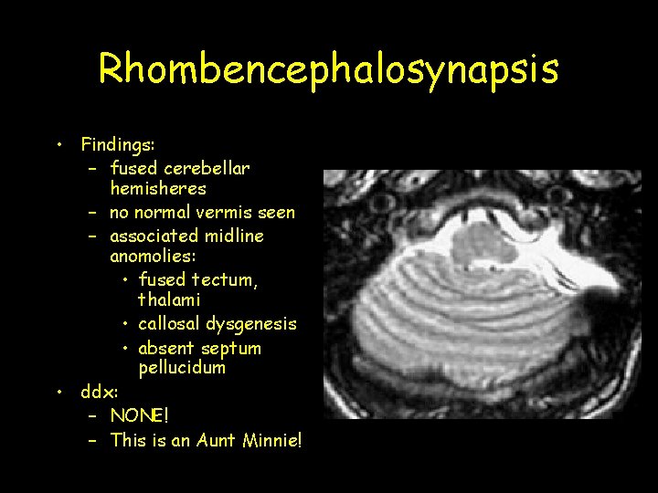 Rhombencephalosynapsis • Findings: – fused cerebellar hemisheres – no normal vermis seen – associated Rhombencephalosynapsis • Findings: – fused cerebellar hemisheres – no normal vermis seen – associated