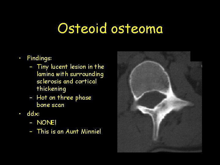 Osteoid osteoma • Findings: – Tiny lucent lesion in the lamina with surrounding sclerosis Osteoid osteoma • Findings: – Tiny lucent lesion in the lamina with surrounding sclerosis