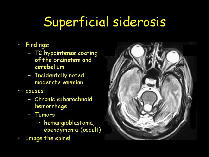 Superficial siderosis • Findings: – T 2 hypointense coating of the brainstem and cerebellum Superficial siderosis • Findings: – T 2 hypointense coating of the brainstem and cerebellum