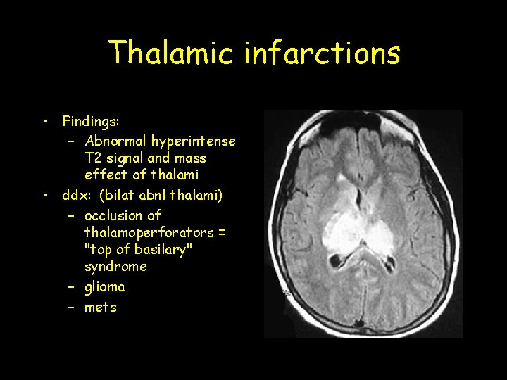 Thalamic infarctions • Findings: – Abnormal hyperintense T 2 signal and mass effect of Thalamic infarctions • Findings: – Abnormal hyperintense T 2 signal and mass effect of