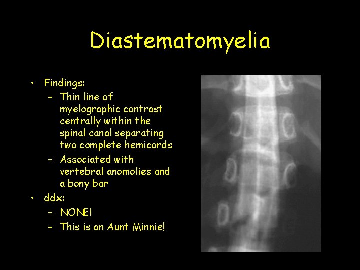 Diastematomyelia • Findings: – Thin line of myelographic contrast centrally within the spinal canal Diastematomyelia • Findings: – Thin line of myelographic contrast centrally within the spinal canal