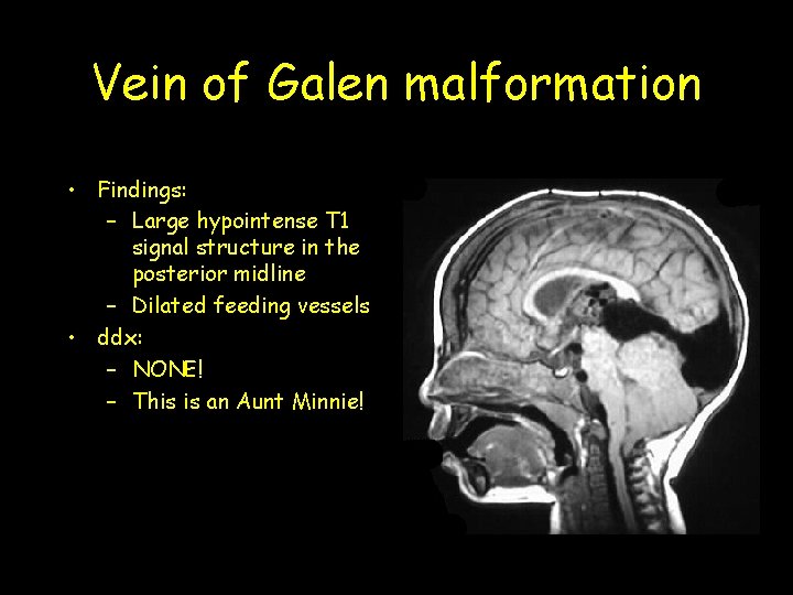 Vein of Galen malformation • Findings: – Large hypointense T 1 signal structure in Vein of Galen malformation • Findings: – Large hypointense T 1 signal structure in