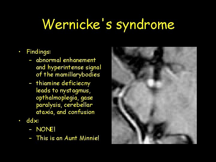 Wernicke's syndrome • Findings: – abnormal enhanement and hyperintense signal of the mamillarybodies – Wernicke's syndrome • Findings: – abnormal enhanement and hyperintense signal of the mamillarybodies –